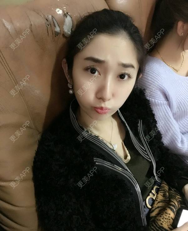 更美 - 更美用户uz9hqyjQmU的淡化皱纹经验 | 抬头纹 | 淡化皱纹 | 鱼尾纹 | 杭州