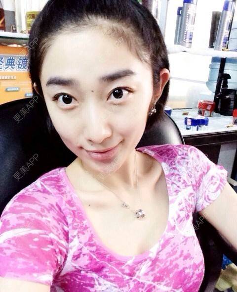 更美 - 更美用户uz9hqyjQmU的淡化皱纹经验 | 抬头纹 | 淡化皱纹 | 鱼尾纹 | 杭州