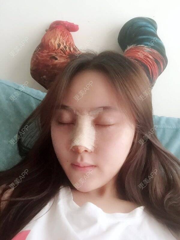 更美 - 做个萌妹纸的隆鼻经验 | 重庆 | 鼻子整形 | 隆鼻