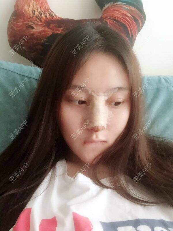 更美 - 做个萌妹纸的隆鼻经验 | 重庆 | 鼻子整形 | 隆鼻