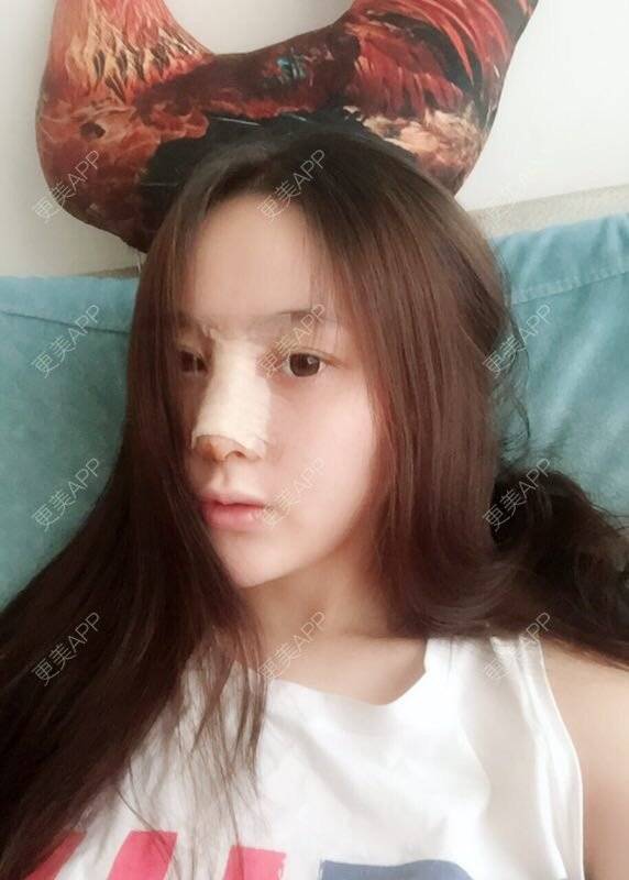 更美 - 做个萌妹纸的隆鼻经验 | 重庆 | 鼻子整形 | 隆鼻