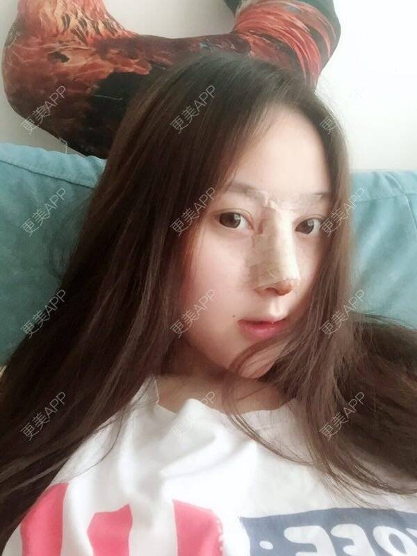 更美 - 做个萌妹纸的隆鼻经验 | 重庆 | 鼻子整形 | 隆鼻