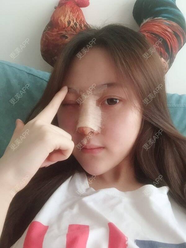 更美 - 做个萌妹纸的隆鼻经验 | 重庆 | 鼻子整形 | 隆鼻