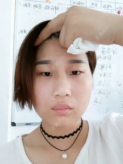 更美 - 画凉～的经验 | 埋线双眼皮术 | 双眼皮 | 广州