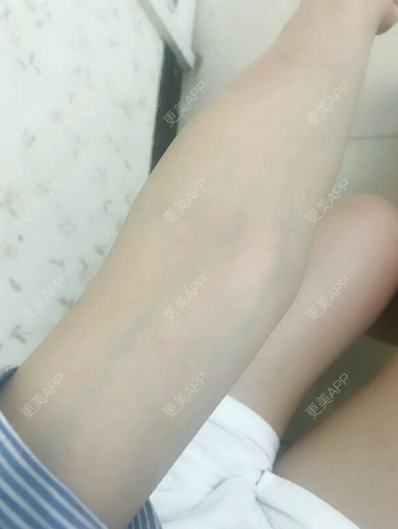 更美 - 网络主播欧美妹子的手臂脱毛经验 | 广州 | 手臂脱毛 | 大腿加小腿激光脱毛 | 脱毛