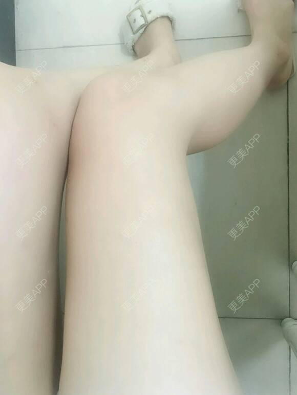 更美 - 网络主播欧美妹子的手臂脱毛经验 | 广州 | 手臂脱毛 | 大腿加小腿激光脱毛 | 脱毛