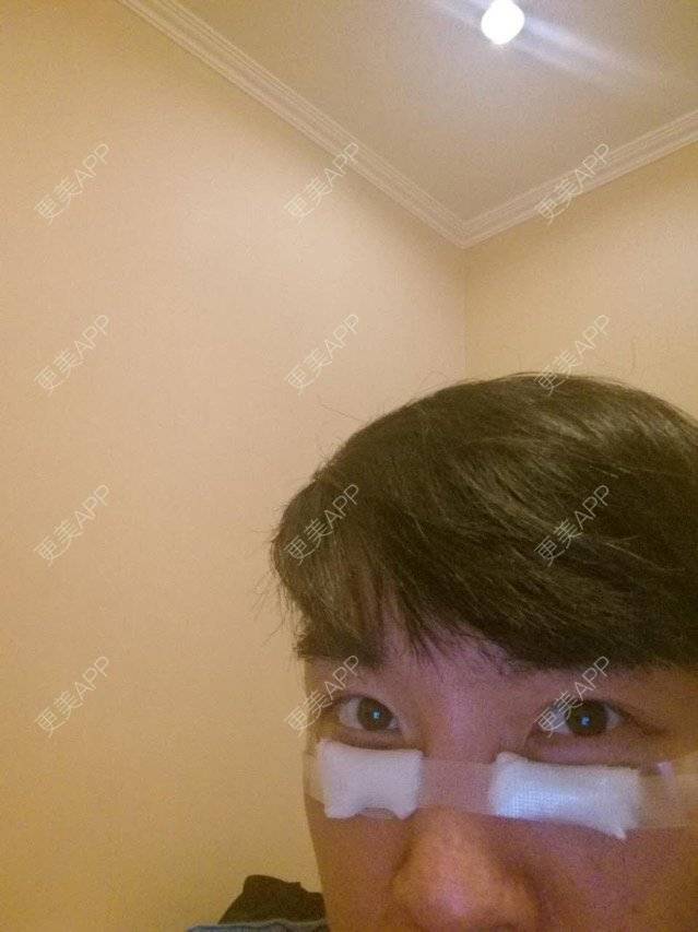更美 - 我是凯哥的激光去眼袋经验 | 去黑眼圈去眼袋 | 眼部整形 | 激光去眼袋 | 北京