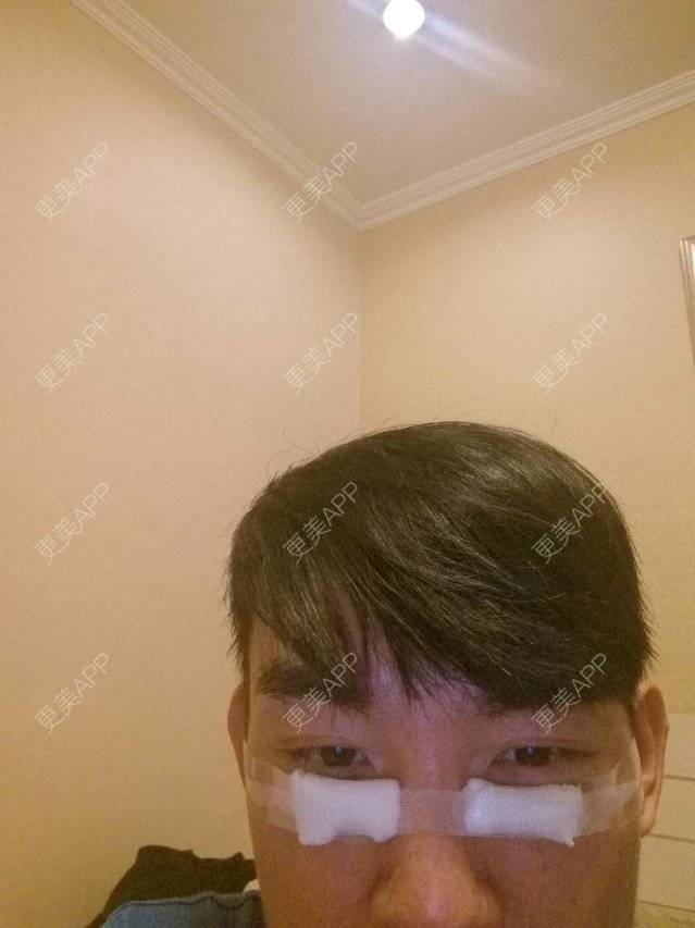 更美 - 我是凯哥的激光去眼袋经验 | 去黑眼圈去眼袋 | 眼部整形 | 激光去眼袋 | 北京