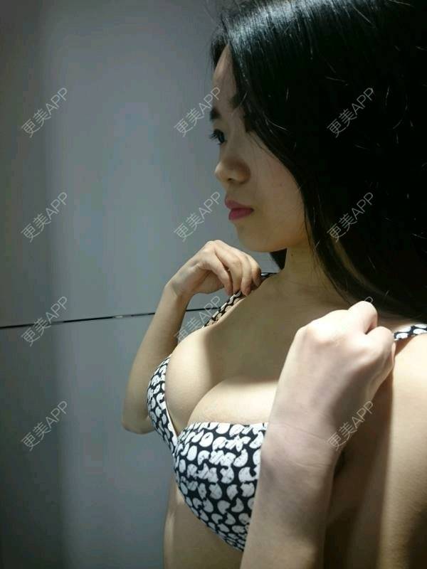更美 - 不怕不怕不怕的假体隆胸经验 | 水滴形假体隆胸 | 胸部塑身 | 假体隆胸 | 成都