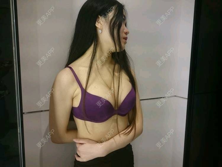 更美 - 不怕不怕不怕的假体隆胸经验 | 水滴形假体隆胸 | 胸部塑身 | 假体隆胸 | 成都