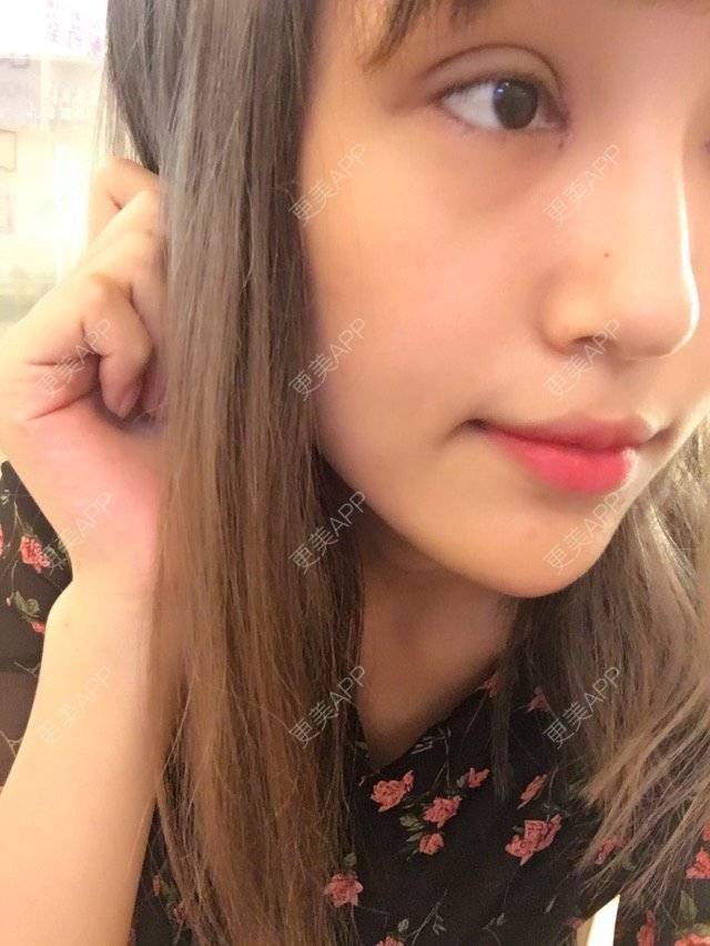 更美 - 菇凉吃醋不怕酸酸的眼部多项经验 | 眼眉整形 | 眼部多项 | 无痕双眼皮 | 广州