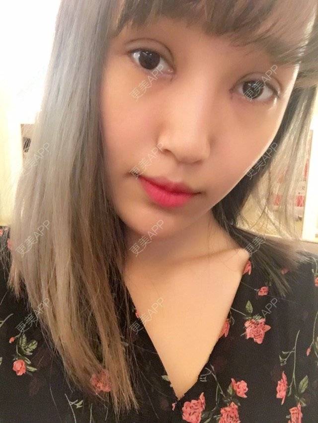 更美 - 菇凉吃醋不怕酸酸的眼部多项经验 | 眼眉整形 | 眼部多项 | 无痕双眼皮 | 广州