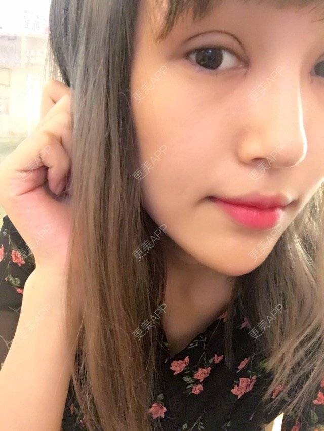 更美 - 菇凉吃醋不怕酸酸的眼部多项经验 | 眼眉整形 | 眼部多项 | 无痕双眼皮 | 广州