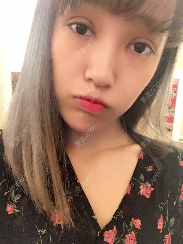 更美 - 菇凉吃醋不怕酸酸的眼部多项经验 | 眼眉整形 | 眼部多项 | 无痕双眼皮 | 广州
