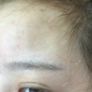 额头填充