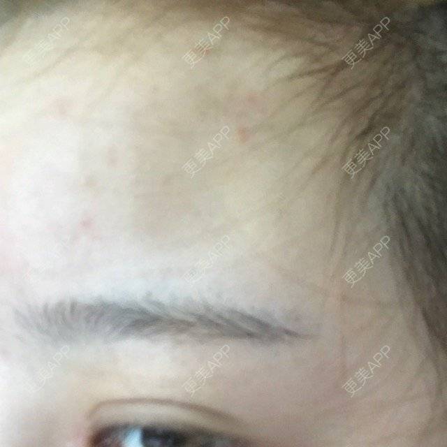 更美 - Sqw的经验 | 额头填充 | 丰额头 | 玻尿酸额头 | 大连