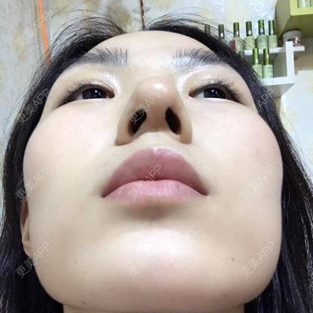 更美 - 大眼小黄人的鼻部膨体假体取出经验 | 上海 | 鼻部膨体假体取出