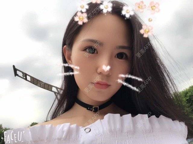 更美 - 大眼小黄人的鼻部膨体假体取出经验 | 上海 | 鼻部膨体假体取出