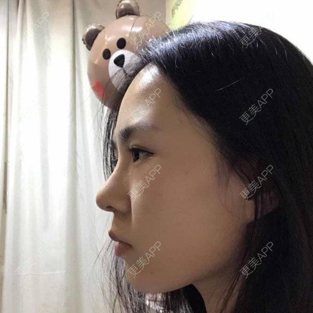 更美 - 大眼小黄人的鼻部膨体假体取出经验 | 上海 | 鼻部膨体假体取出