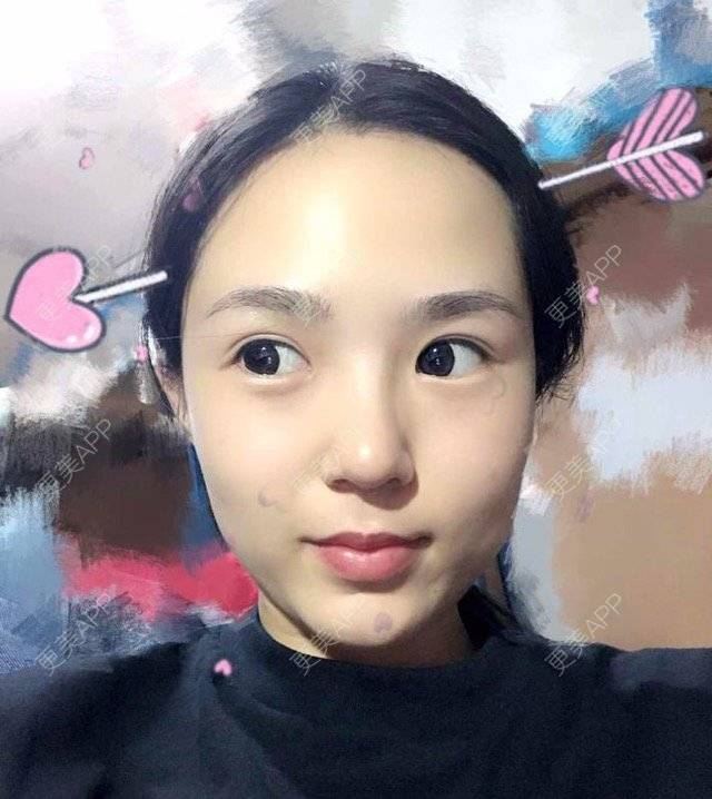 更美 - 大眼小黄人的鼻部膨体假体取出经验 | 上海 | 鼻部膨体假体取出