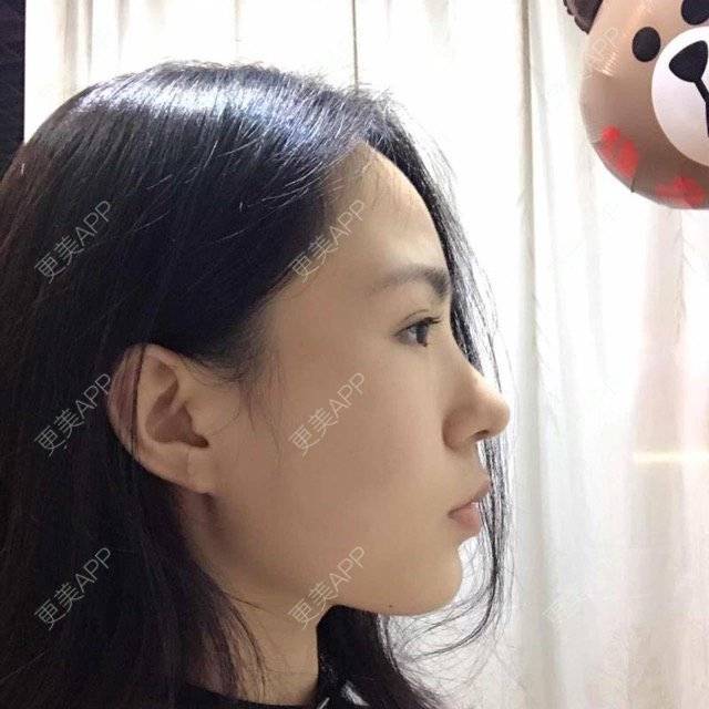 更美 - 大眼小黄人的鼻部膨体假体取出经验 | 上海 | 鼻部膨体假体取出