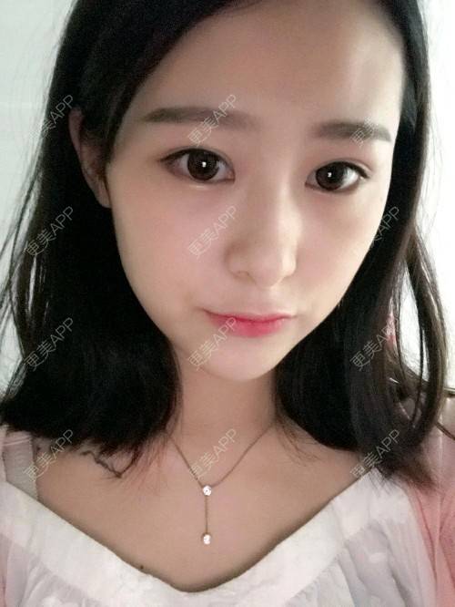 更美 - 腿短猫不吃鱼的玻尿酸下巴经验 | 玻尿酸下巴 | 武汉