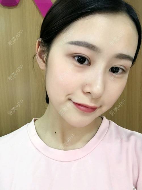更美 - 腿短猫不吃鱼的玻尿酸下巴经验 | 玻尿酸下巴 | 武汉