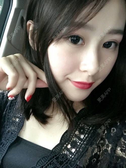 更美 - 腿短猫不吃鱼的玻尿酸下巴经验 | 玻尿酸下巴 | 武汉
