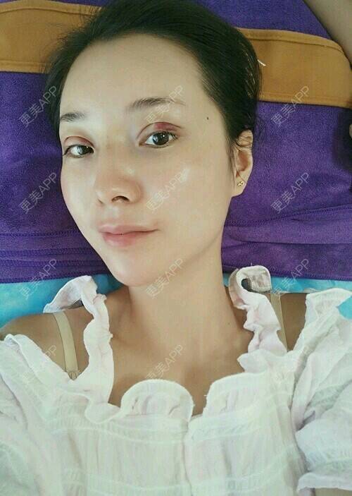 更美 - 郁筱筱的玻尿酸经验 | 玻尿酸 | 隆鼻 | 西安