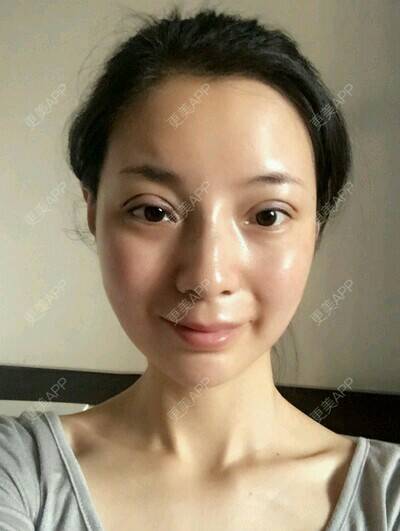更美 - 郁筱筱的瘦脸除皱经验 | 注射美容 | 瘦脸除皱 | 注射瘦脸· | 西安