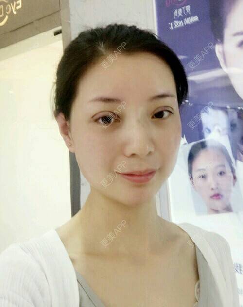 更美 - 郁筱筱的瘦脸除皱经验 | 注射美容 | 瘦脸除皱 | 注射瘦脸· | 西安