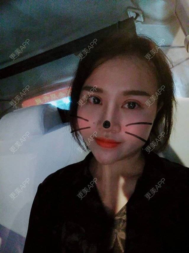 眼综合,眼综合前后对比照_艳艳大王眼综合前后对比照_术后18天__更美