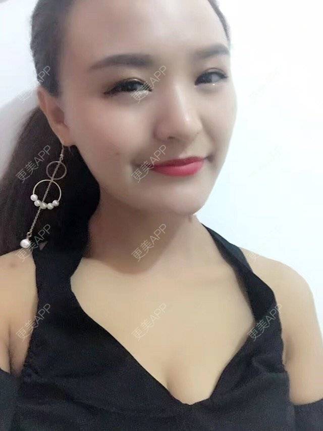 更美 - 木槿、夏的淡化皱纹经验 | 淡化皱纹 | 注射botox除抬头纹 | 面部轮廓. | 深圳