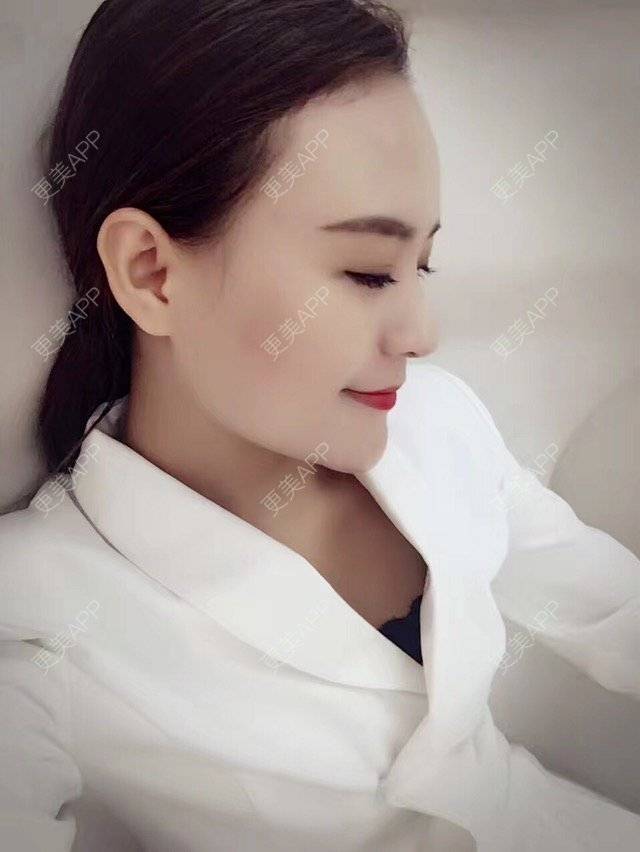 更美 - 木槿、夏的淡化皱纹经验 | 淡化皱纹 | 注射botox除抬头纹 | 面部轮廓. | 深圳