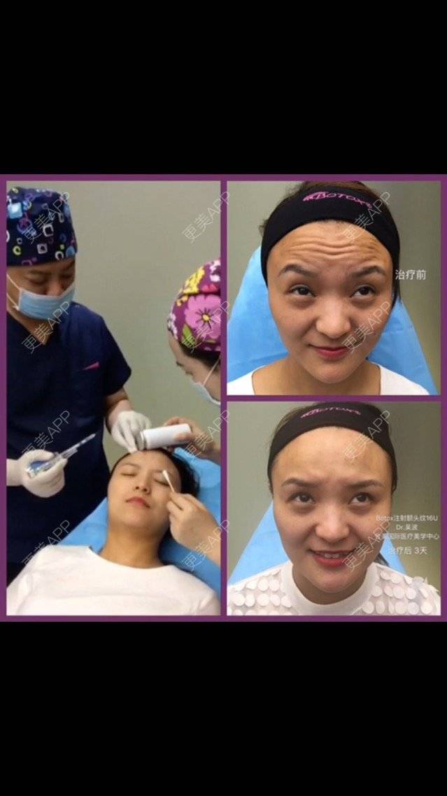 更美 - 木槿、夏的淡化皱纹经验 | 淡化皱纹 | 注射botox除抬头纹 | 面部轮廓. | 深圳
