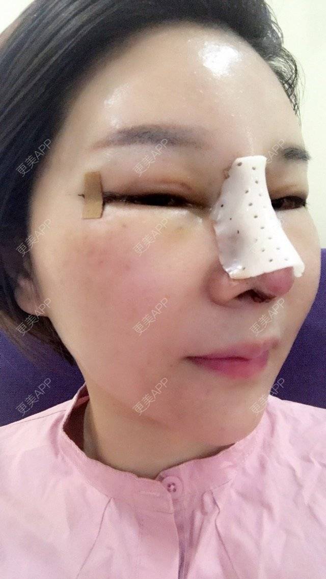 更美 - 李悠邢陪我到老的鼻部膨体假体取出经验 | 鼻部膨体假体取出 | 外开眼角 | 膨体鼻综合 | 广州