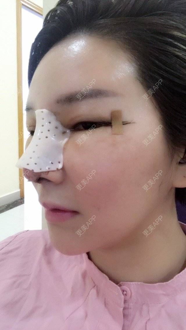 更美 - 李悠邢陪我到老的鼻部膨体假体取出经验 | 鼻部膨体假体取出 | 外开眼角 | 膨体鼻综合 | 广州