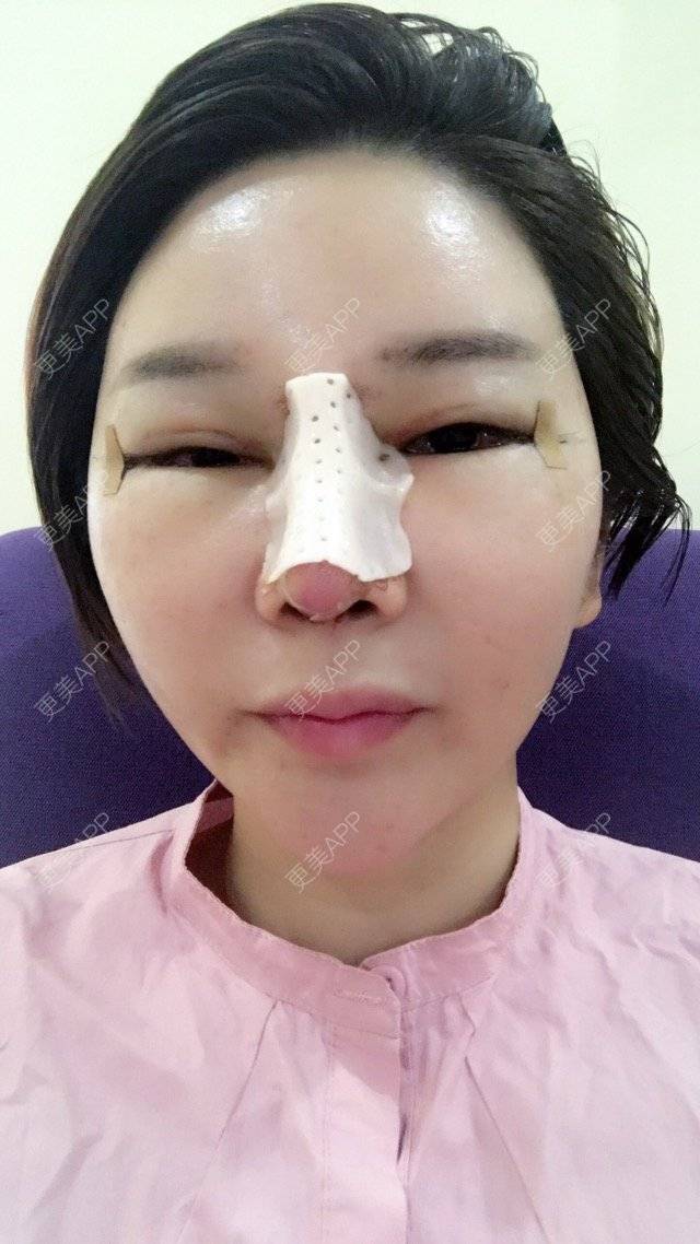 更美 - 李悠邢陪我到老的鼻部膨体假体取出经验 | 鼻部膨体假体取出 | 外开眼角 | 膨体鼻综合 | 广州