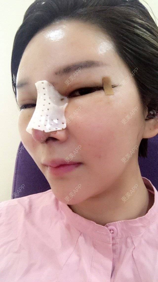 更美 - 李悠邢陪我到老的鼻部膨体假体取出经验 | 鼻部膨体假体取出 | 外开眼角 | 膨体鼻综合 | 广州