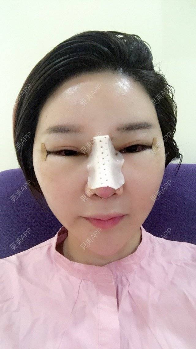 更美 - 李悠邢陪我到老的鼻部膨体假体取出经验 | 鼻部膨体假体取出 | 外开眼角 | 膨体鼻综合 | 广州