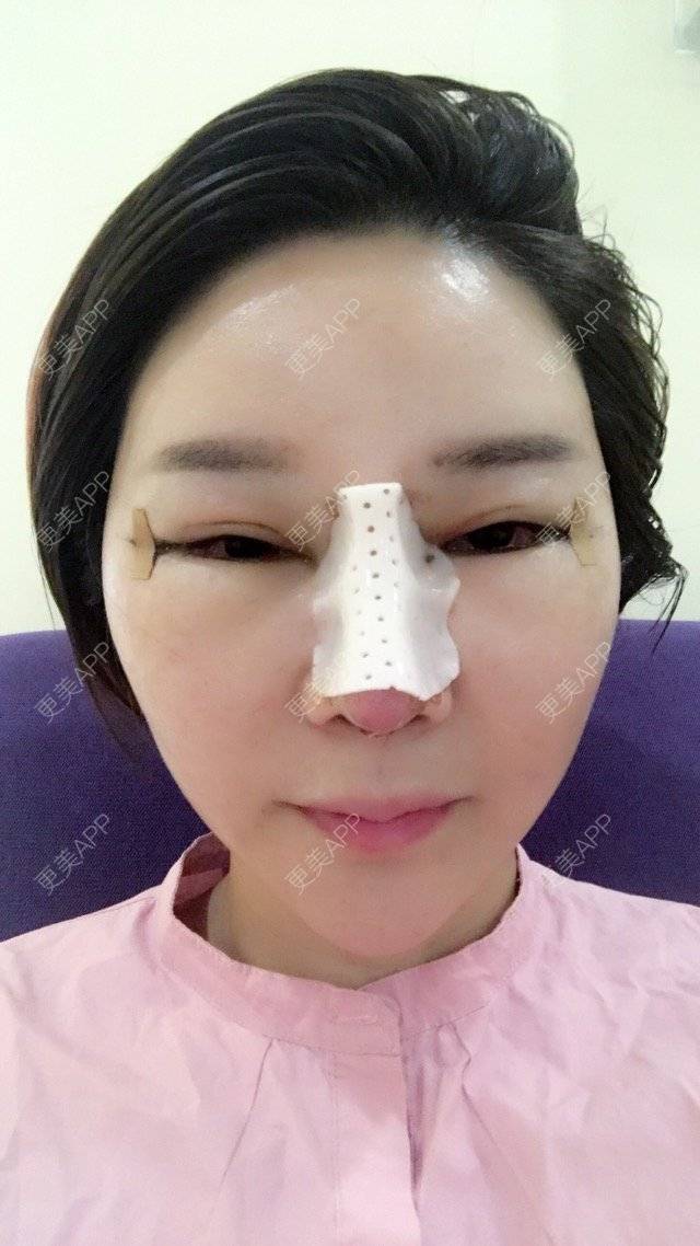 更美 - 李悠邢陪我到老的鼻部膨体假体取出经验 | 鼻部膨体假体取出 | 外开眼角 | 膨体鼻综合 | 广州