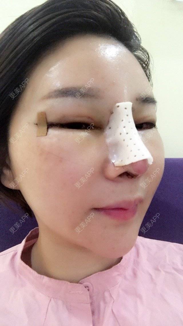 更美 - 李悠邢陪我到老的鼻部膨体假体取出经验 | 鼻部膨体假体取出 | 外开眼角 | 膨体鼻综合 | 广州