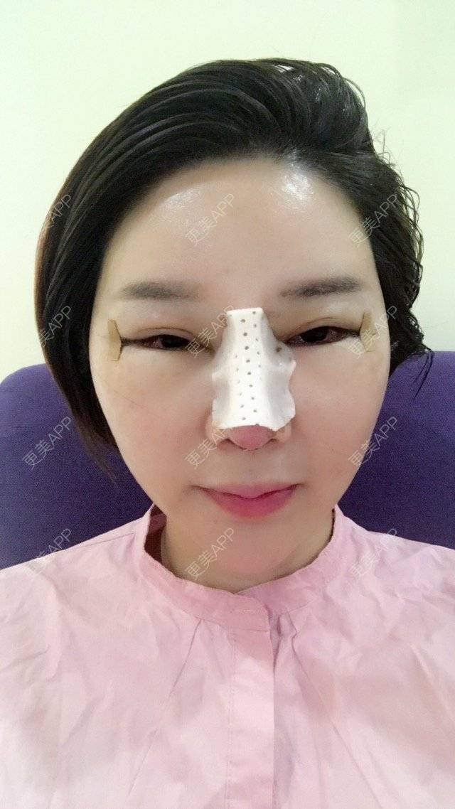 更美 - 李悠邢陪我到老的鼻部膨体假体取出经验 | 鼻部膨体假体取出 | 外开眼角 | 膨体鼻综合 | 广州