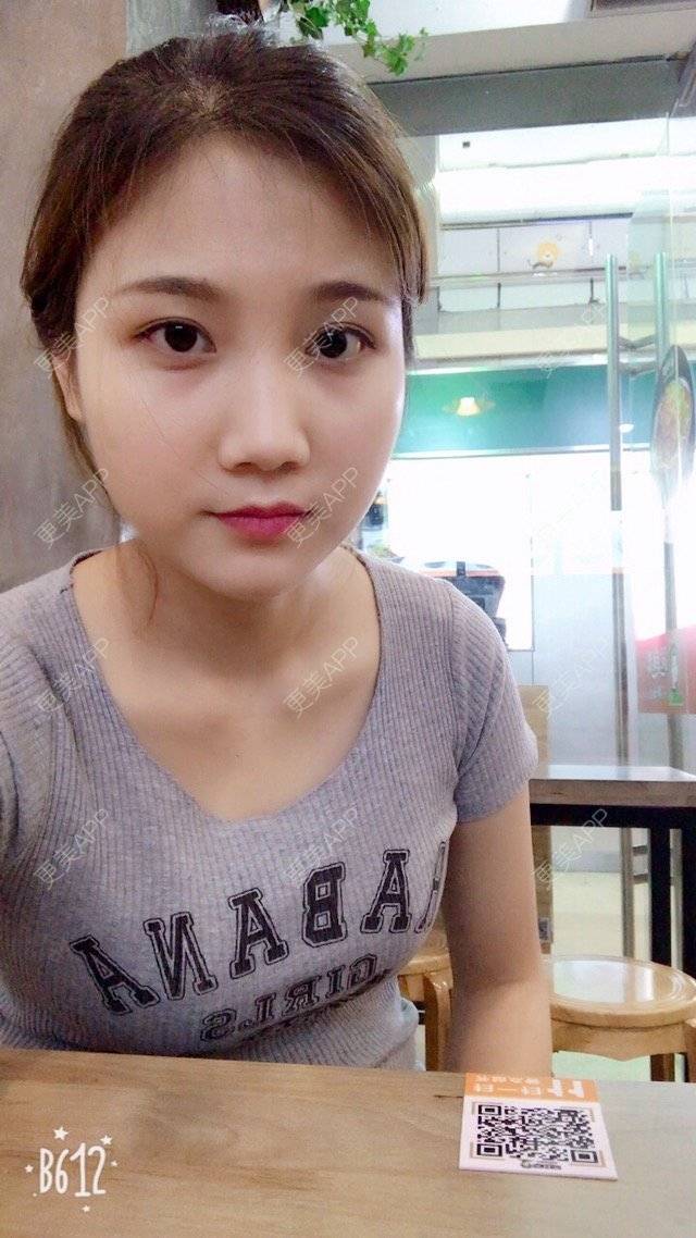 更美 - 李安琪^^的除皱瘦脸经验 | botox瘦脸 | botox | 除皱瘦脸 | 深圳