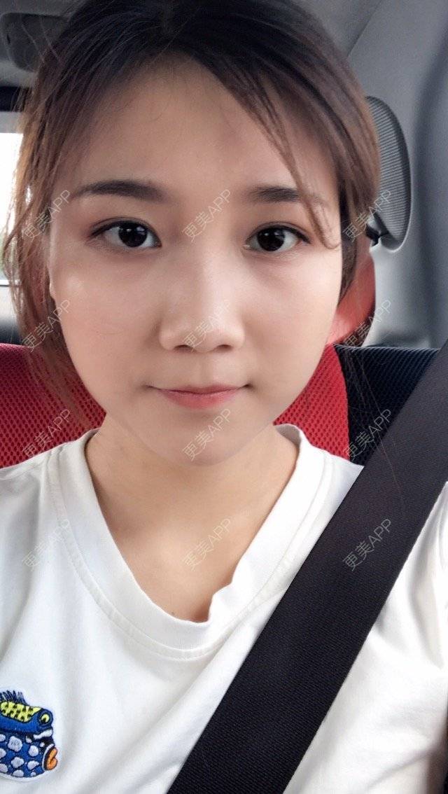 更美 - 李安琪^^的除皱瘦脸经验 | botox瘦脸 | botox | 除皱瘦脸 | 深圳