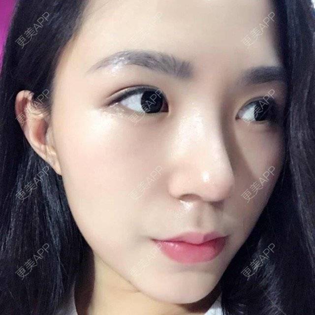更美 - 大眼小黄人的鼻部膨体假体取出经验 | 上海 | 鼻部膨体假体取出