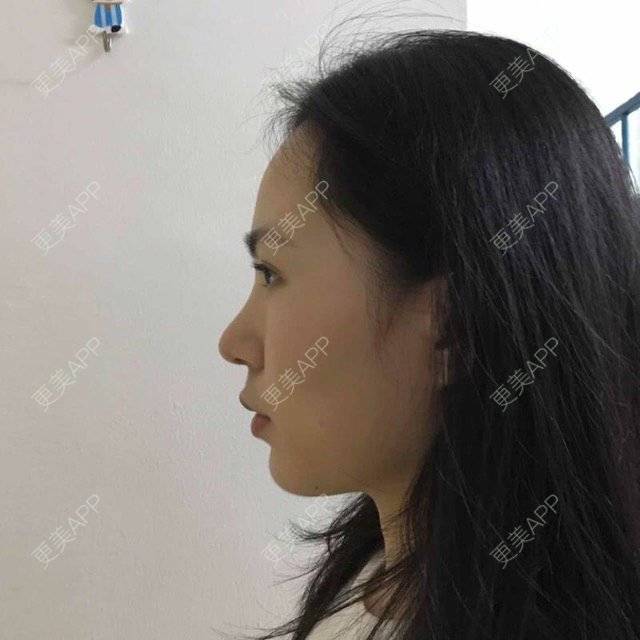 更美 - 大眼小黄人的鼻部膨体假体取出经验 | 上海 | 鼻部膨体假体取出