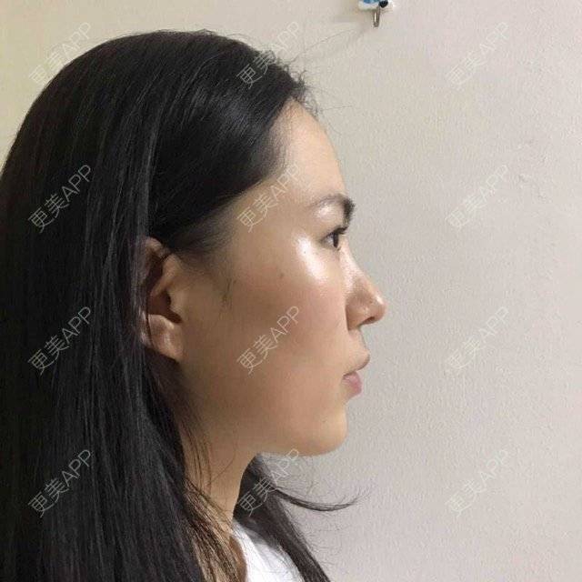 更美 - 大眼小黄人的鼻部膨体假体取出经验 | 上海 | 鼻部膨体假体取出