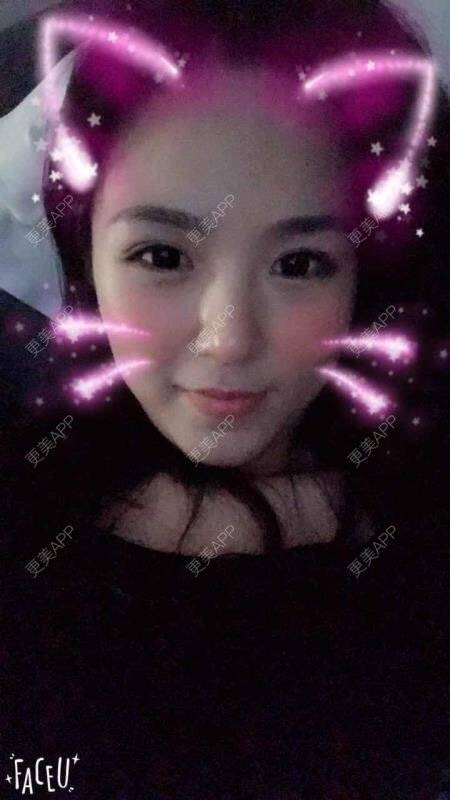 更美 - 大眼小黄人的鼻部膨体假体取出经验 | 上海 | 鼻部膨体假体取出