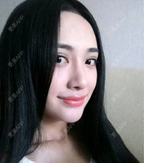 更美 - 珍珠儿儿的埋线提升经验 | 埋线提升 | 婴儿肥 | 下颌缘 | 杭州